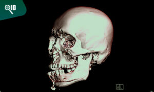 Ortho Imagen | Cone Beam lo mejor en Tomografías 3D para implantes dentales