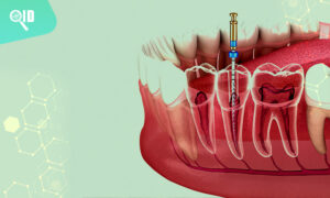 Ortho Imagen | Radiografía Dental para endodoncia – Ortho Imagen Digital