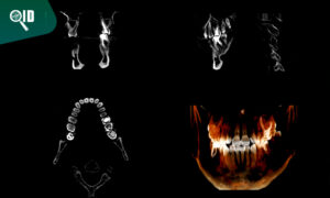 Ortho Imagen | Tomografía de Cráneo aplicaciones en la Implantología Dental