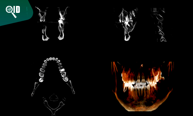 Ortho Imagen | Tomografía de Cráneo aplicaciones en la Implantología Dental